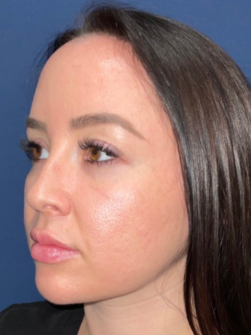 Inmode by Dr. Haydon Before & After Gallery - Patient 55709071 - Image 6