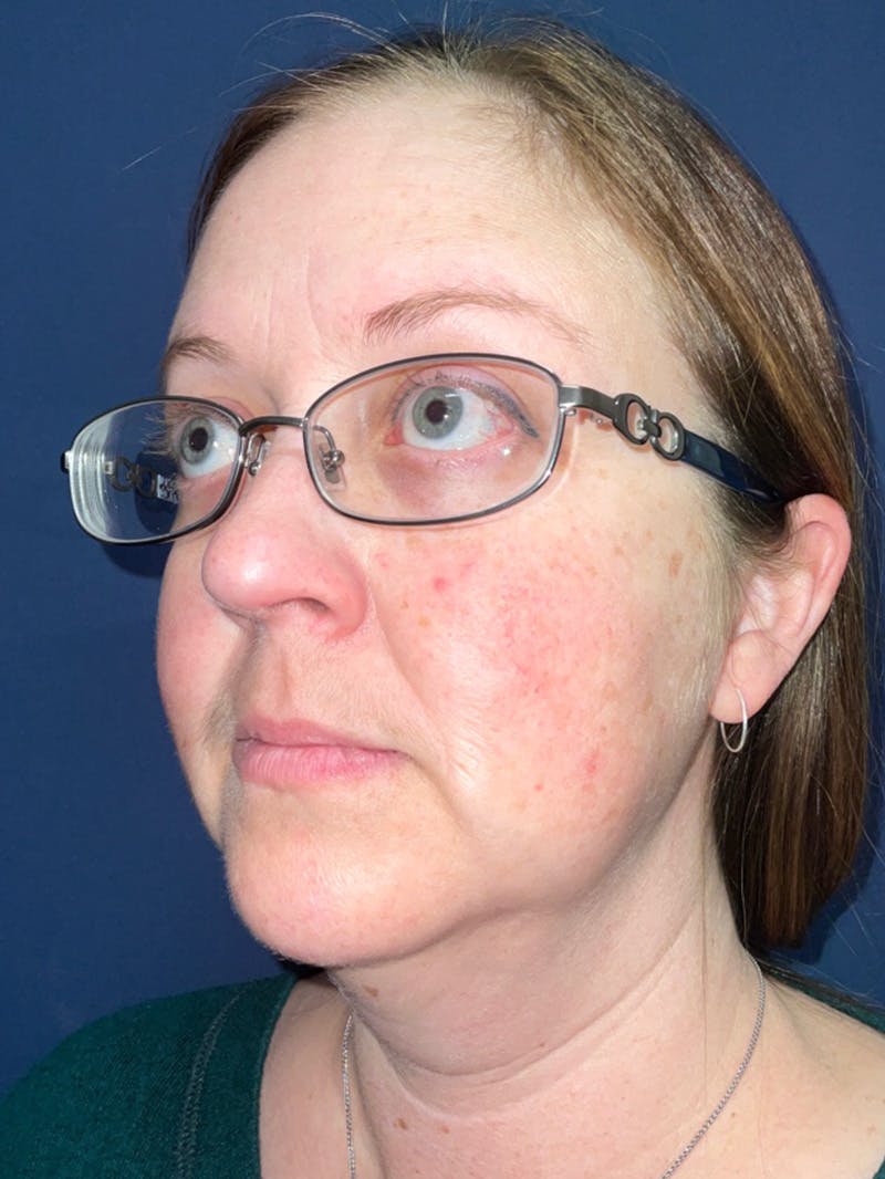 Inmode by Dr. Haydon Before & After Gallery - Patient 55709072 - Image 5