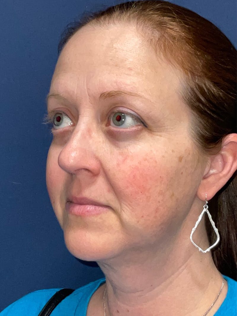 Inmode by Dr. Haydon Before & After Gallery - Patient 55709072 - Image 6