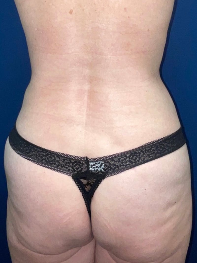 Inmode by Dr. Haydon Before & After Gallery - Patient 55709073 - Image 4