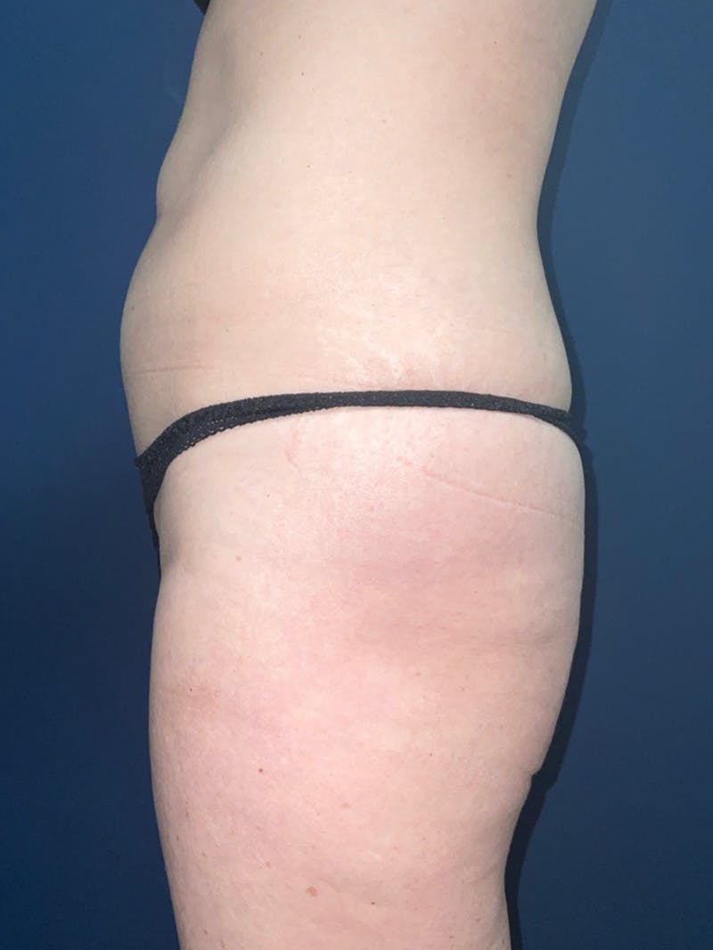 Inmode by Dr. Haydon Before & After Gallery - Patient 55709073 - Image 5