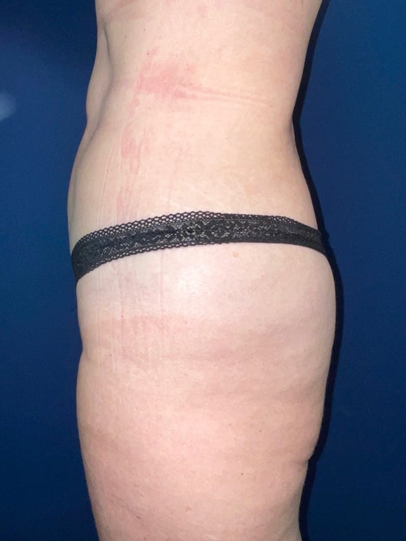 Inmode by Dr. Haydon Before & After Gallery - Patient 55709073 - Image 6