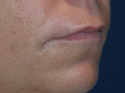 Lip Augmentation by Dr. Haydon Before & After Gallery - Patient 55709075 - Image 1