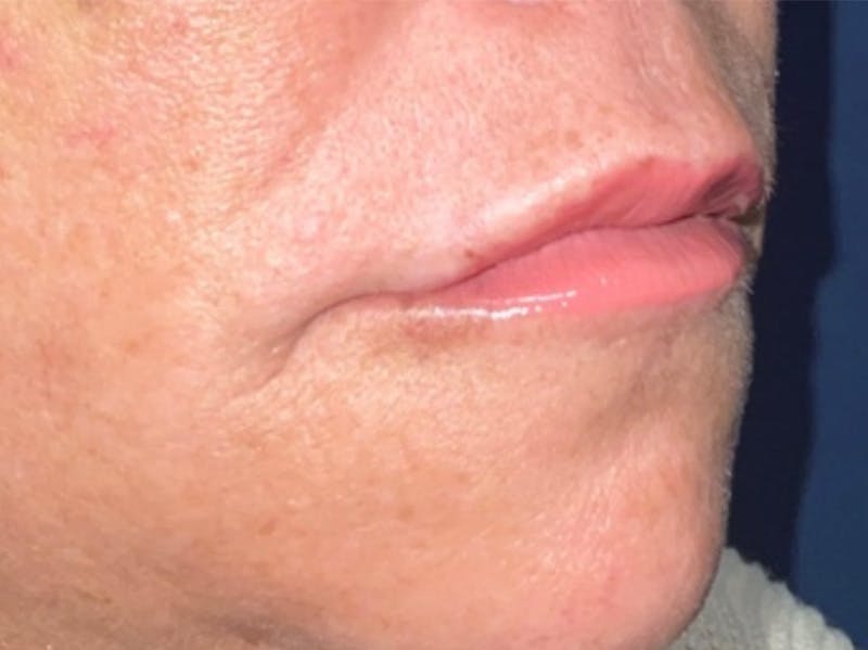 Lip Augmentation by Dr. Haydon Before & After Gallery - Patient 55709075 - Image 2