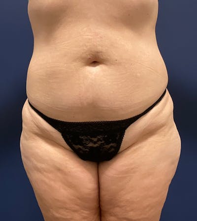 Liposuction by Dr. Haydon Before & After Gallery - Patient 55709077 - Image 1