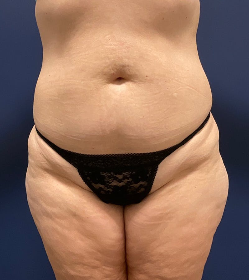Liposuction by Dr. Haydon Before & After Gallery - Patient 55709077 - Image 1