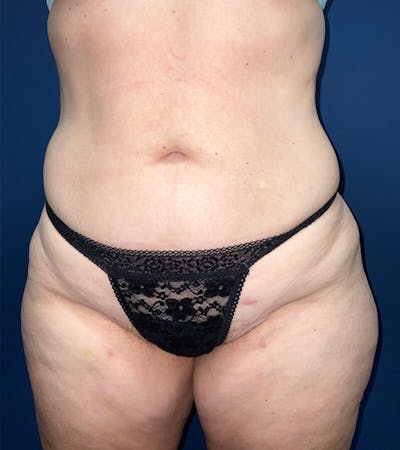 Liposuction by Dr. Haydon Before & After Gallery - Patient 55709077 - Image 2