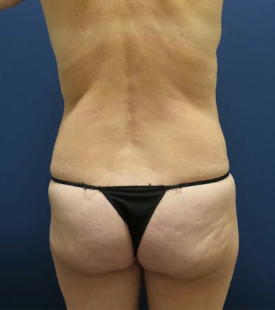Liposuction by Dr. Haydon Before & After Gallery - Patient 55709078 - Image 1