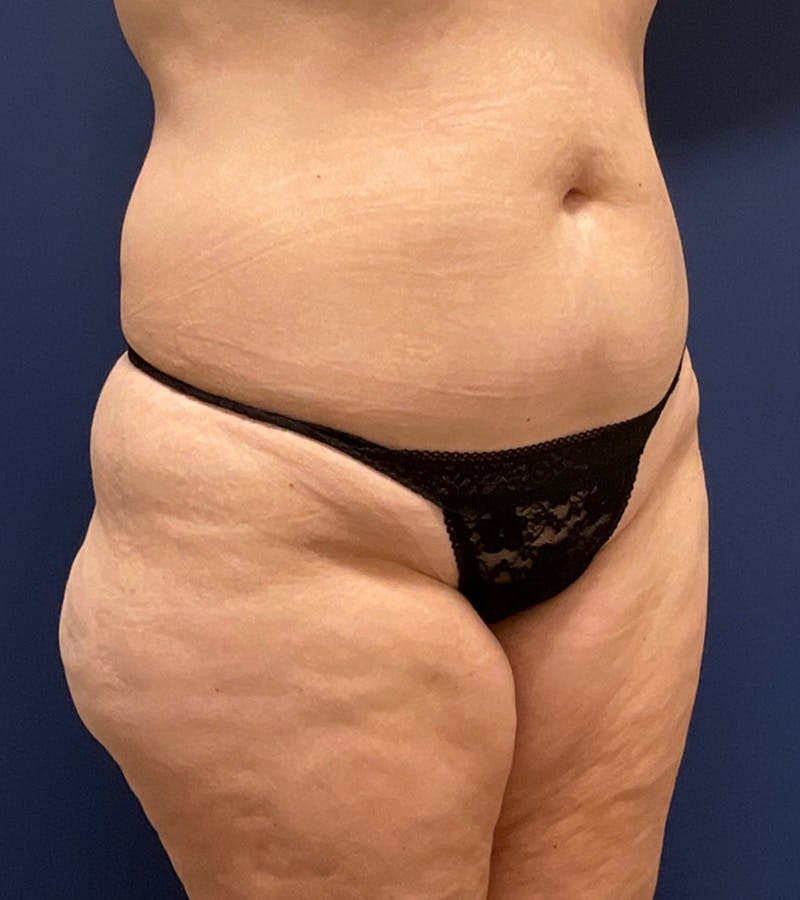 Liposuction by Dr. Haydon Before & After Gallery - Patient 55709077 - Image 3