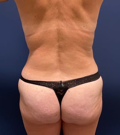 Liposuction by Dr. Haydon Before & After Gallery - Patient 55709078 - Image 2
