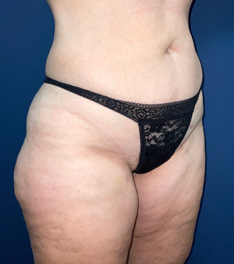 Liposuction by Dr. Haydon Before & After Gallery - Patient 55709077 - Image 4