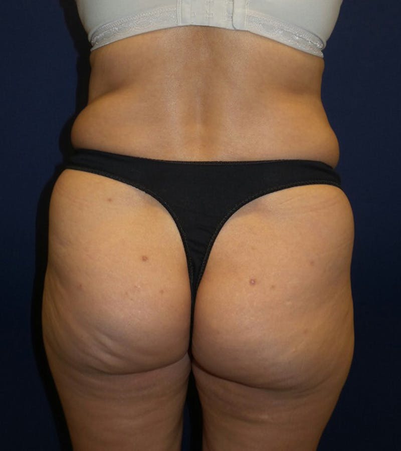 Liposuction by Dr. Haydon Before & After Gallery - Patient 55709077 - Image 5