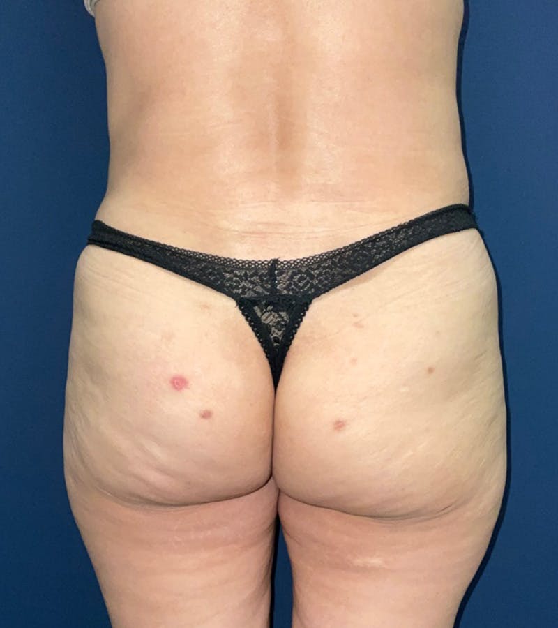 Liposuction by Dr. Haydon Before & After Gallery - Patient 55709077 - Image 6