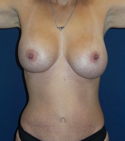 Mommy Makeover by Dr. Haydon Before & After Gallery - Patient 55709081 - Image 2