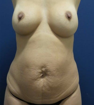 Mommy Makeover by Dr. Haydon Before & After Gallery - Patient 55709083 - Image 1