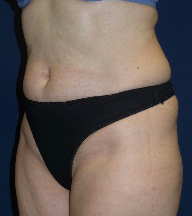 Tummy Tuck by Dr. Haydon Before & After Gallery - Patient 55709086 - Image 1