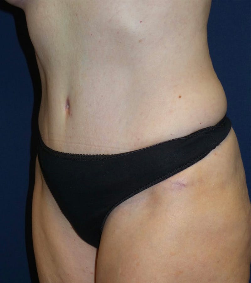 Tummy Tuck by Dr. Haydon Before & After Gallery - Patient 55709086 - Image 2