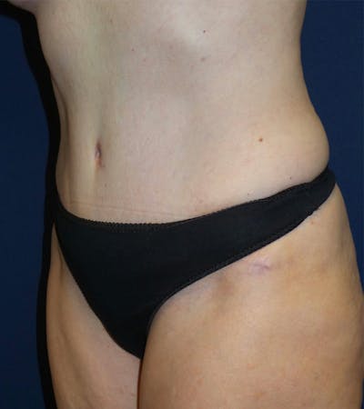 Tummy Tuck by Dr. Haydon Before & After Gallery - Patient 55709086 - Image 2
