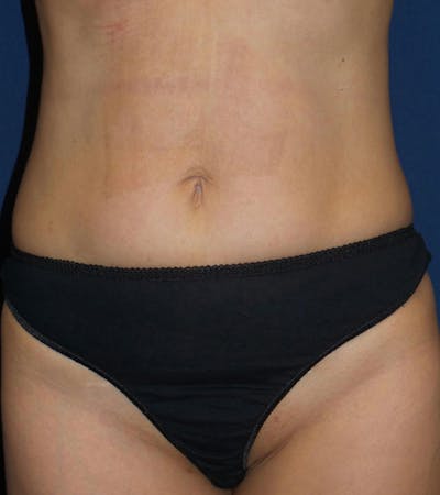Tummy Tuck by Dr. Haydon Before & After Gallery - Patient 55709087 - Image 1