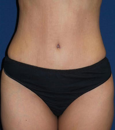 Tummy Tuck by Dr. Haydon Before & After Gallery - Patient 55709087 - Image 2