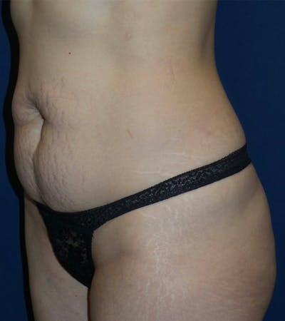 Tummy Tuck by Dr. Haydon Before & After Gallery - Patient 55709100 - Image 1