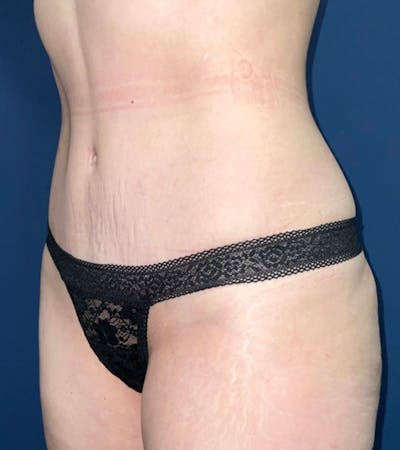 Tummy Tuck by Dr. Haydon Before & After Gallery - Patient 55709100 - Image 2