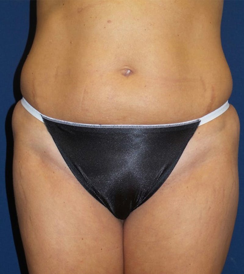 Tummy Tuck by Dr. Haydon Before & After Gallery - Patient 55709099 - Image 1