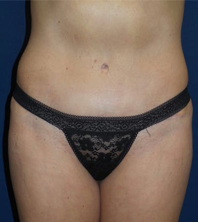 Tummy Tuck by Dr. Haydon Before & After Gallery - Patient 55709099 - Image 2
