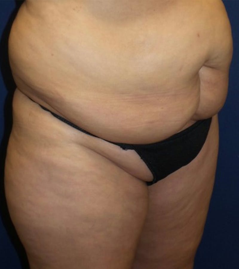 Tummy Tuck by Dr. Haydon Before & After Gallery - Patient 55709096 - Image 1