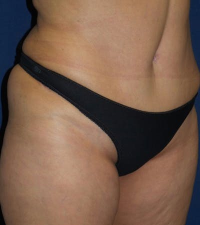Tummy Tuck by Dr. Haydon Before & After Gallery - Patient 55709096 - Image 2