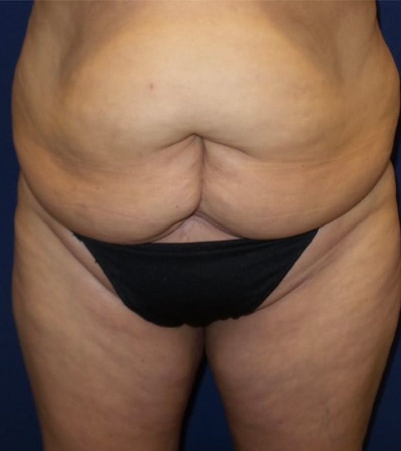 Tummy Tuck by Dr. Haydon Before & After Gallery - Patient 55709096 - Image 3