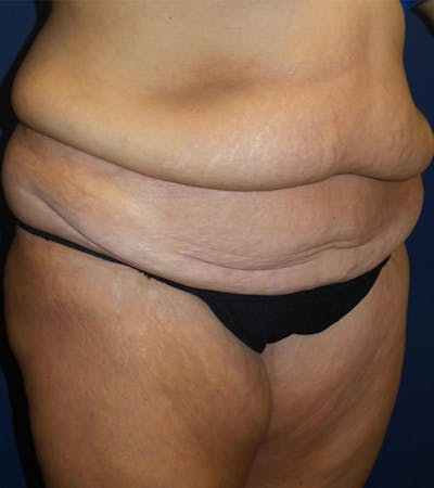 Tummy Tuck by Dr. Haydon Before & After Gallery - Patient 55709088 - Image 1