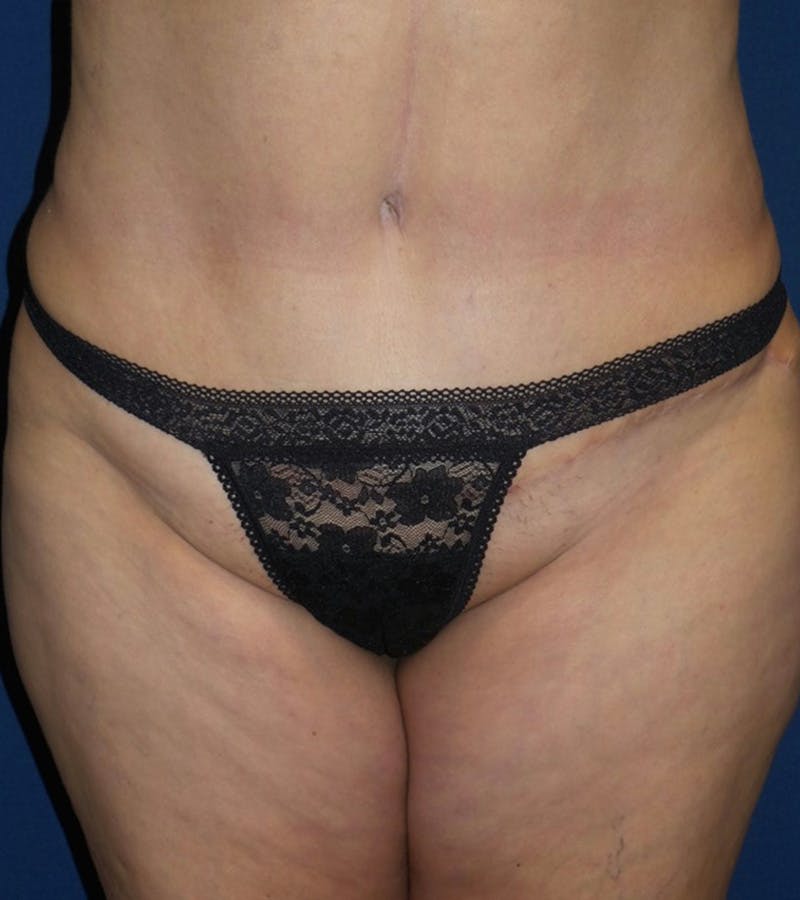 Tummy Tuck by Dr. Haydon Before & After Gallery - Patient 55709096 - Image 4