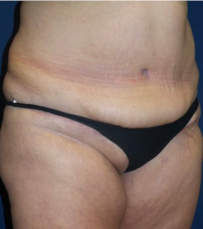 Tummy Tuck by Dr. Haydon Before & After Gallery - Patient 55709088 - Image 2