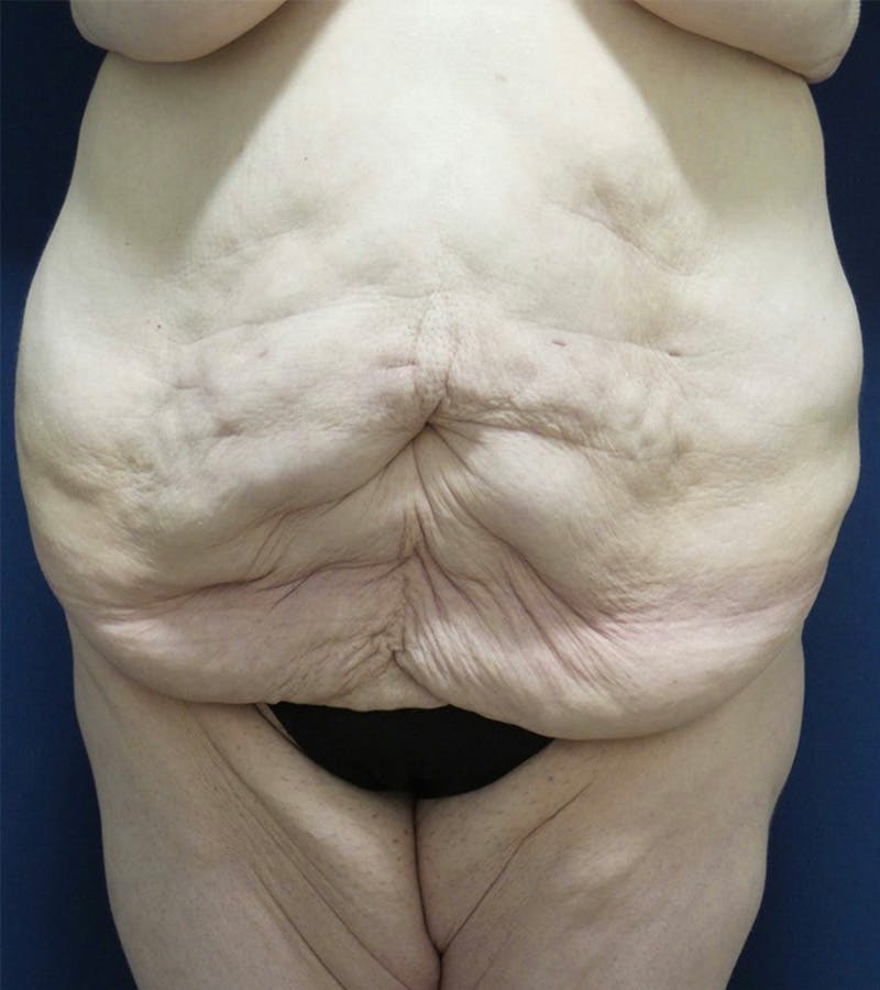 Tummy Tuck by Dr. Haydon Before & After Gallery - Patient 55709089 - Image 1