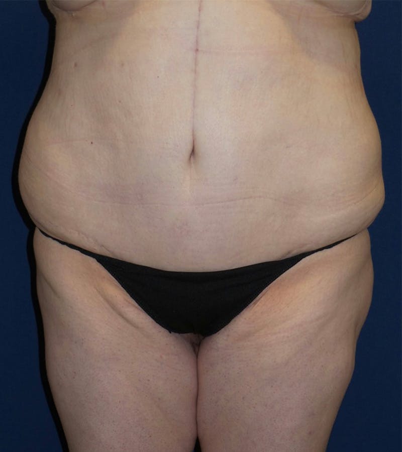 Tummy Tuck by Dr. Haydon Before & After Gallery - Patient 55709089 - Image 2