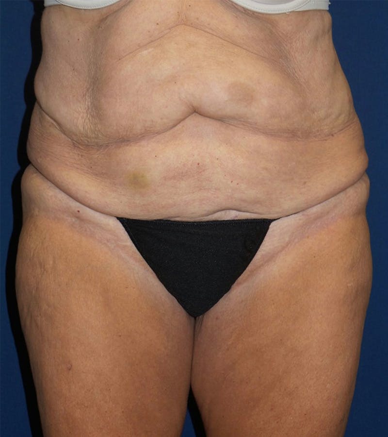 Tummy Tuck by Dr. Haydon Before & After Gallery - Patient 55709098 - Image 1