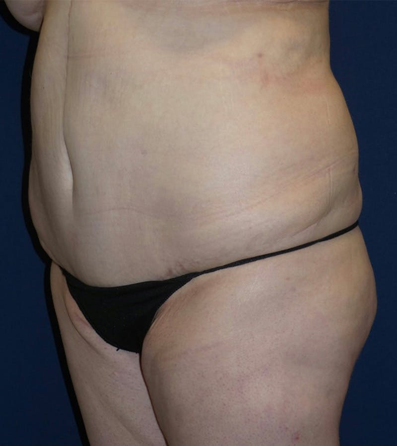 Tummy Tuck by Dr. Haydon Before & After Gallery - Patient 55709089 - Image 4