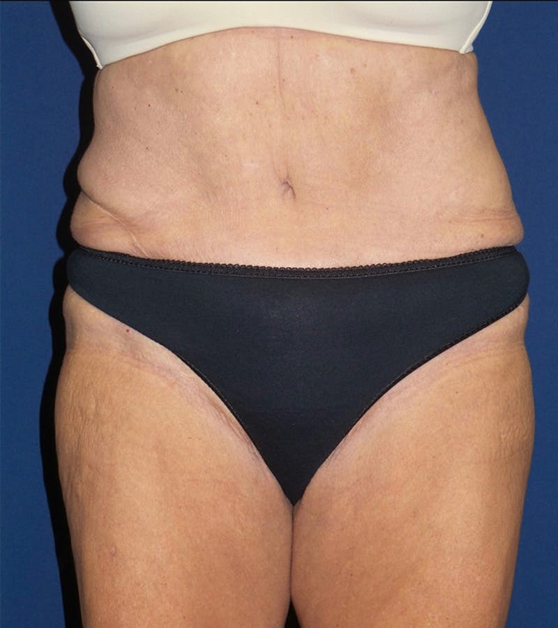 Tummy Tuck by Dr. Haydon Before & After Gallery - Patient 55709098 - Image 2