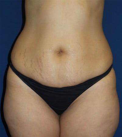 Tummy Tuck by Dr. Haydon Before & After Gallery - Patient 55709095 - Image 1