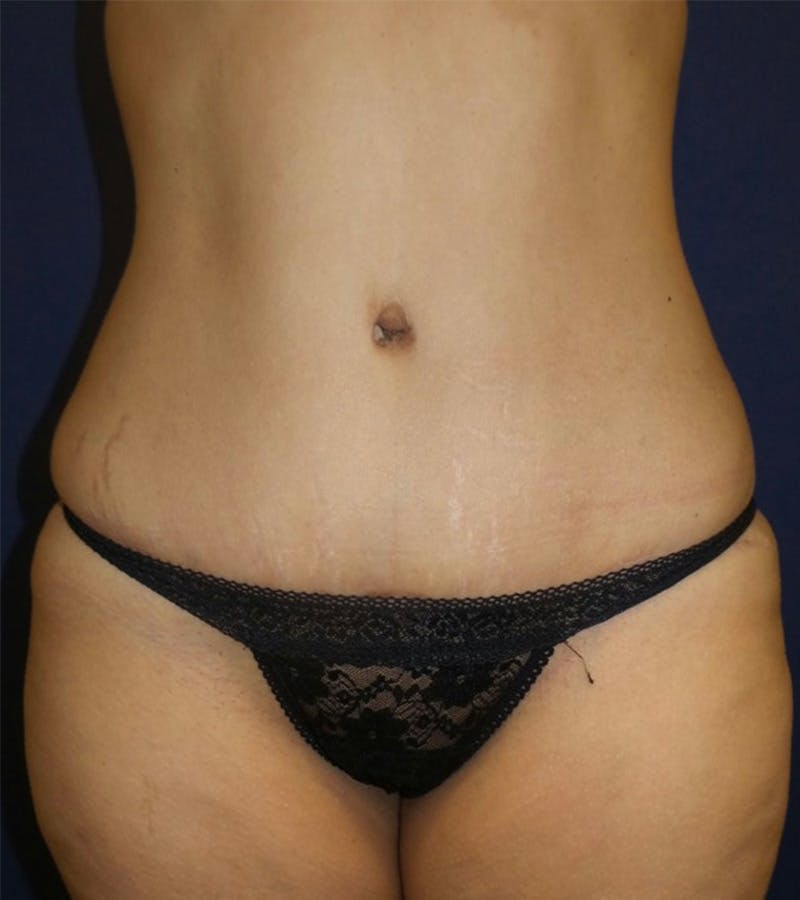 Tummy Tuck by Dr. Haydon Before & After Gallery - Patient 55709095 - Image 2