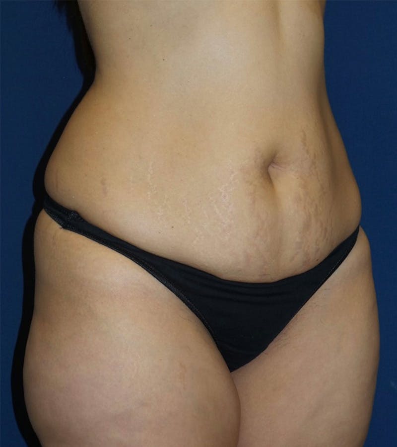 Tummy Tuck by Dr. Haydon Before & After Gallery - Patient 55709095 - Image 3