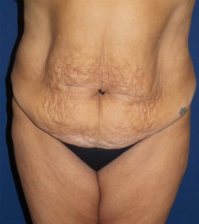 Tummy Tuck by Dr. Haydon Before & After Gallery - Patient 55709097 - Image 1