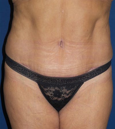 Tummy Tuck by Dr. Haydon Before & After Gallery - Patient 55709097 - Image 2