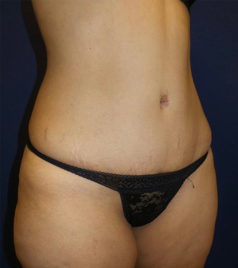 Tummy Tuck by Dr. Haydon Before & After Gallery - Patient 55709095 - Image 4