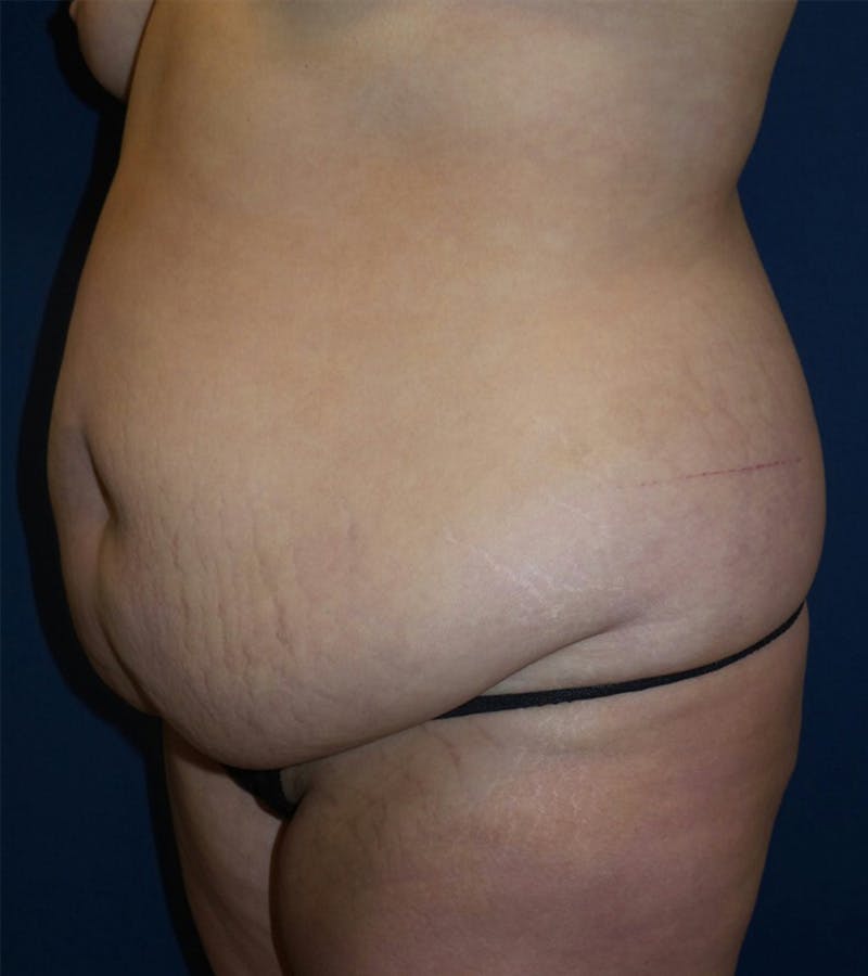 Tummy Tuck by Dr. Haydon Before & After Gallery - Patient 55709090 - Image 1
