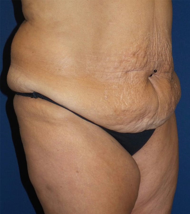 Tummy Tuck by Dr. Haydon Before & After Gallery - Patient 55709097 - Image 3