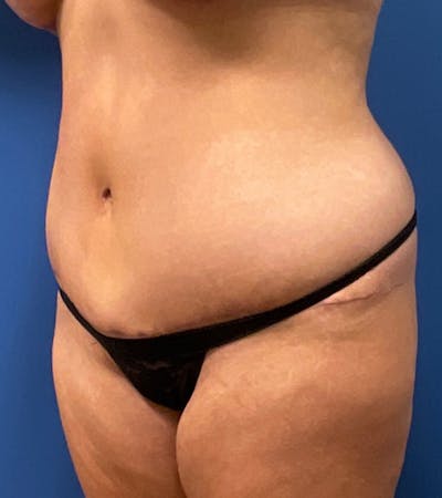 Tummy Tuck by Dr. Haydon Before & After Gallery - Patient 55709090 - Image 2