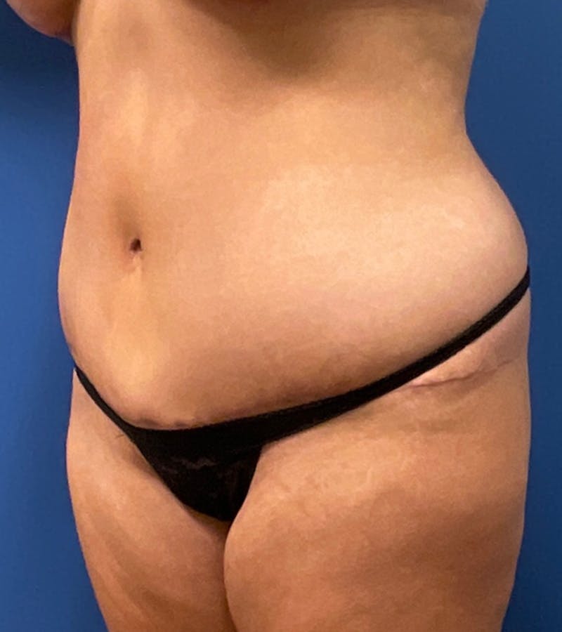 Tummy Tuck by Dr. Haydon Before & After Gallery - Patient 55709090 - Image 2