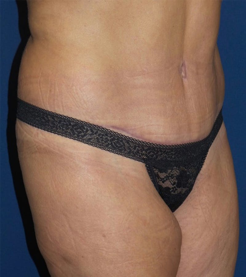Tummy Tuck by Dr. Haydon Before & After Gallery - Patient 55709097 - Image 4